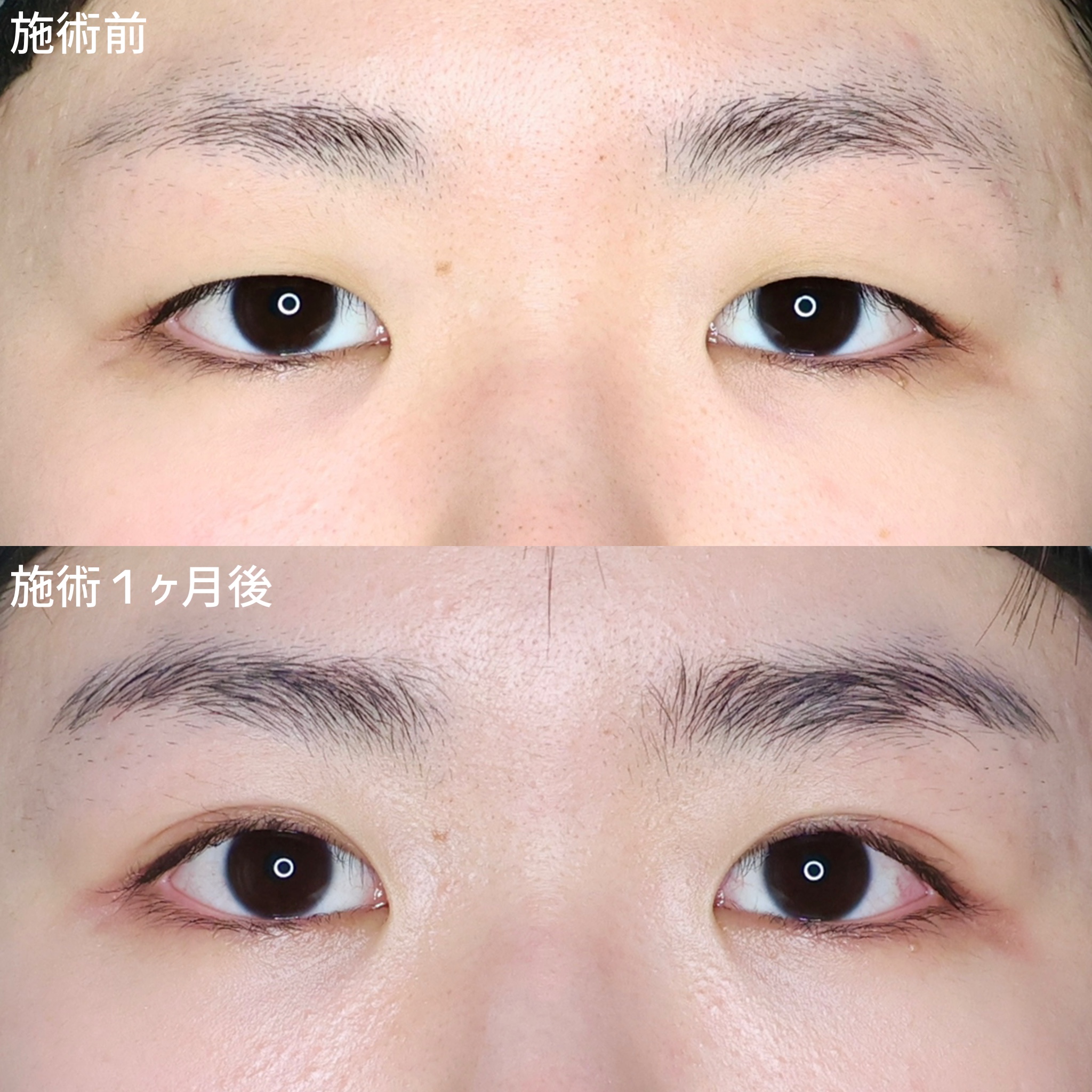患者様のお目元に合った自然で優しいナチュラル二重！