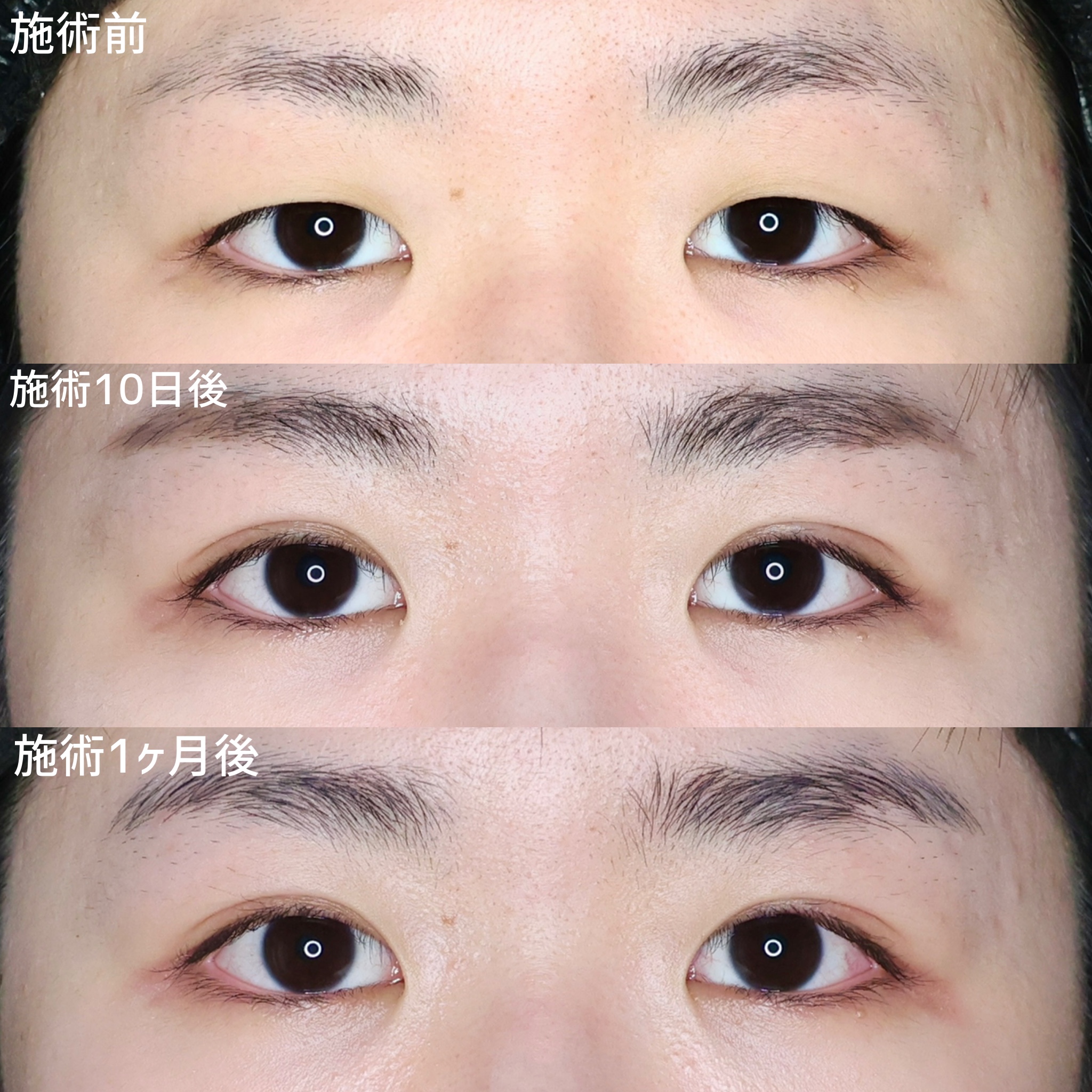 二重埋没法の症例写真 施術前後 