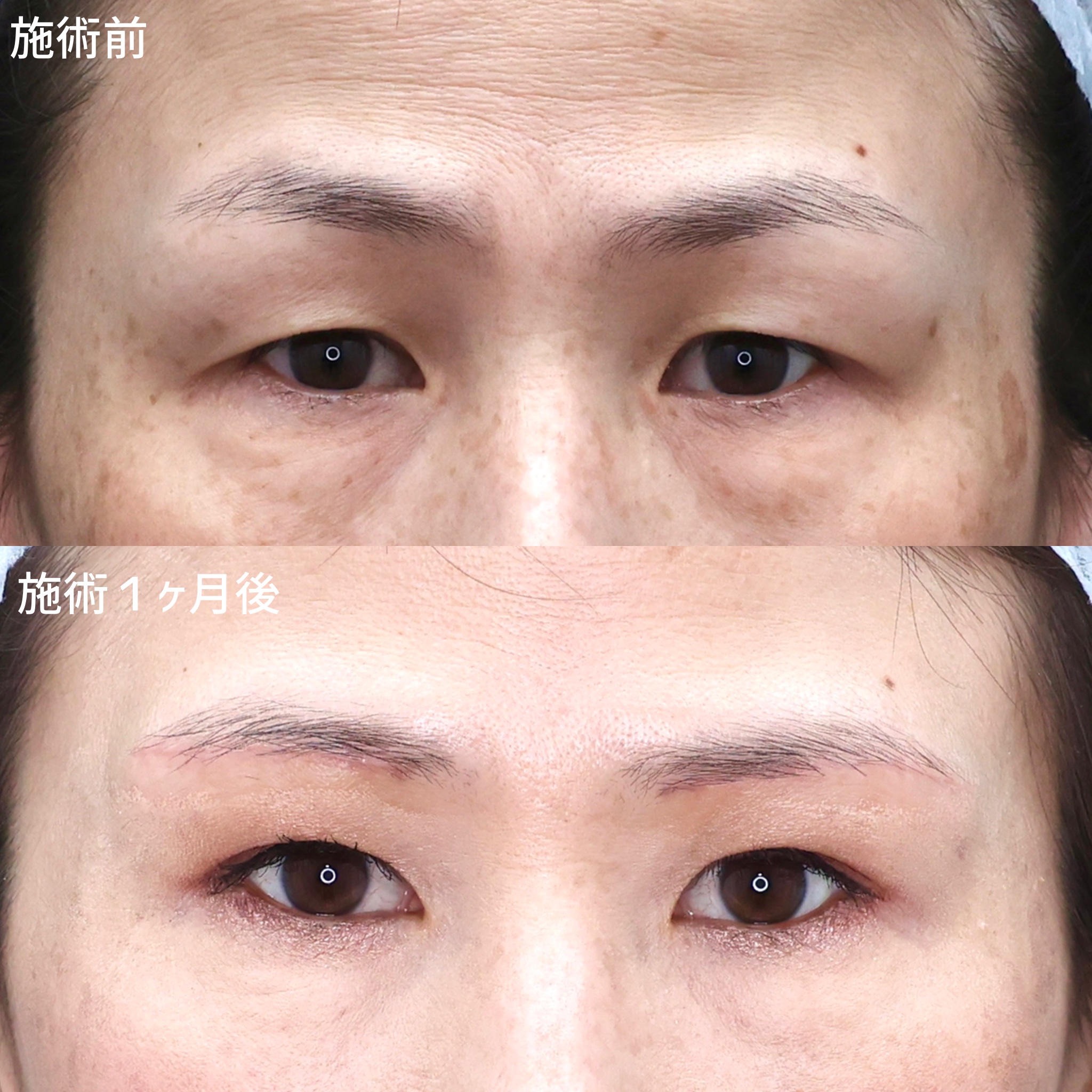 眉毛下切開術の症例画像