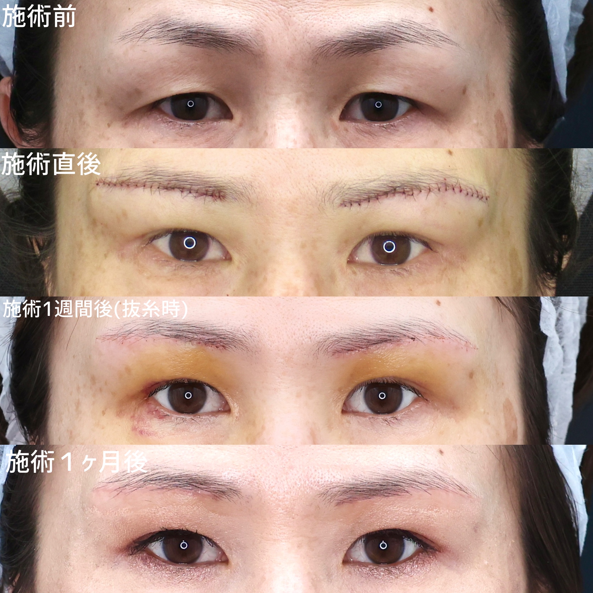 眉毛下切開術の症例写真 施術前後