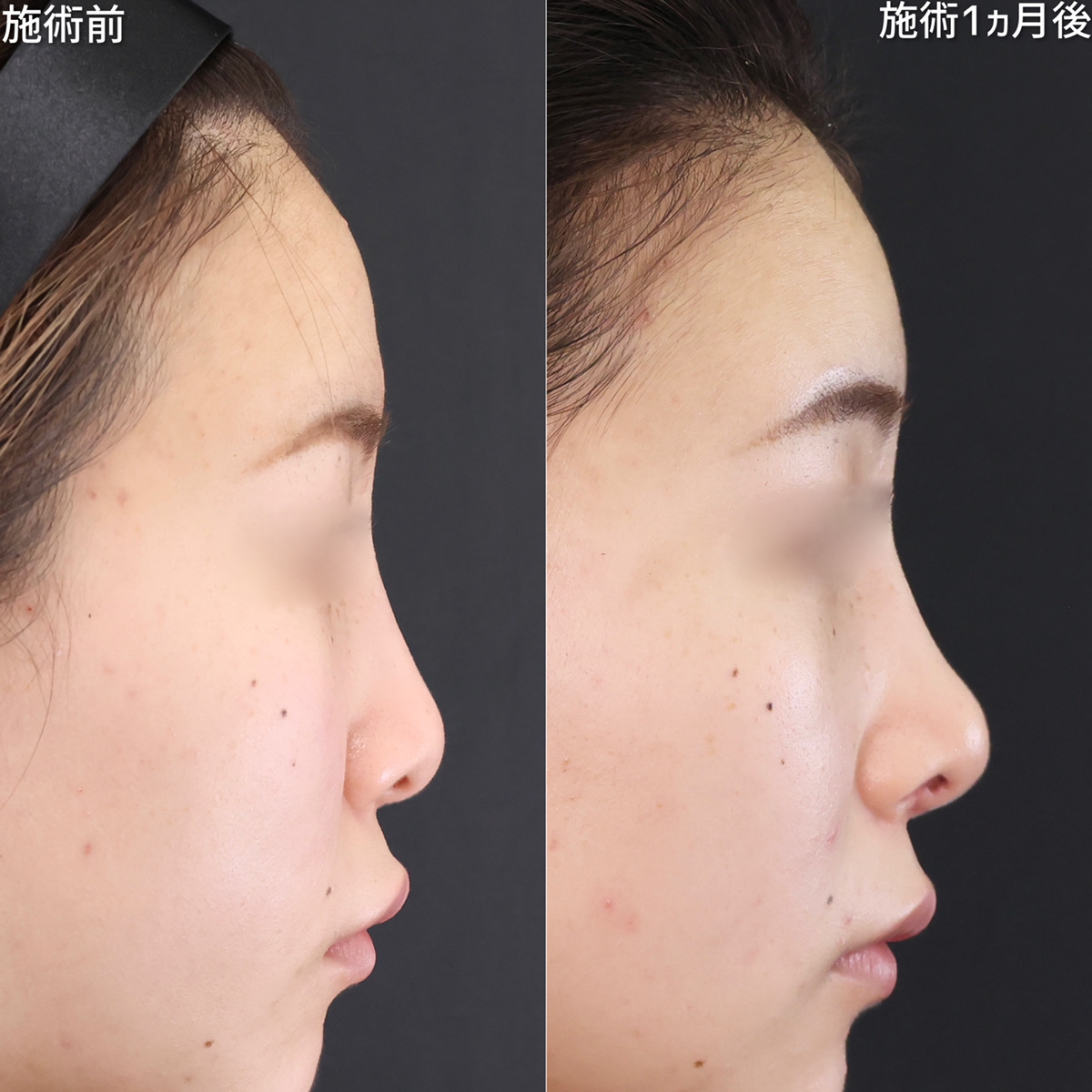 鼻尖注射玻尿酸 | 日本領先的美容、健康與再生醫學診所 | Bianca Ginza