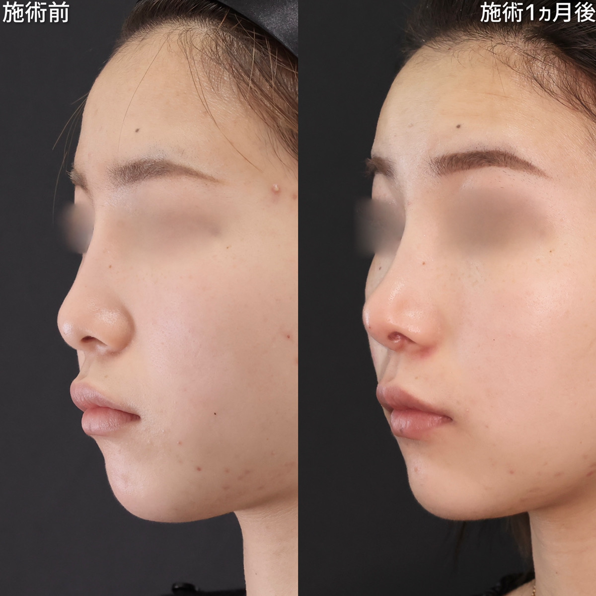 鼻尖形成・鼻尖縮小/鼻先軟骨移植/おでこ・こめかみのヒアルロン酸注射の症例写真 施術前後 1ヵ月
