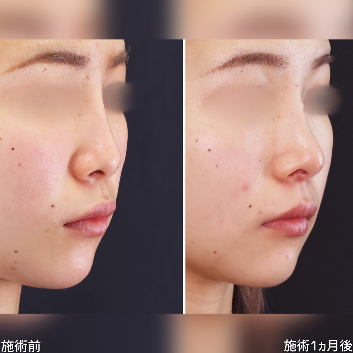 鼻尖形成・鼻尖縮小/鼻先軟骨移植/おでこ・こめかみのヒアルロン酸注射の症例写真 施術前後 1ヵ月