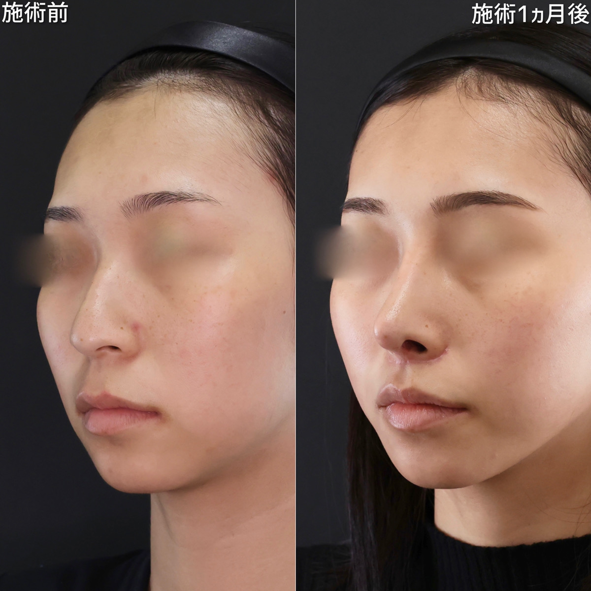 鼻中隔延長術/鼻尖形成・鼻尖縮小/鼻先軟骨移植の症例写真 施術前後 