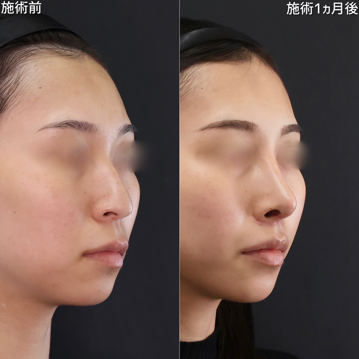 鼻+人中+輪郭を整えて、より端麗なお顔立ちに