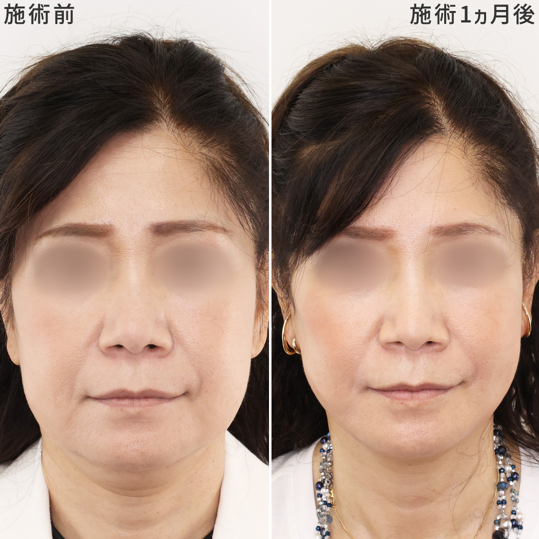 【－10才】すっきりとした輪郭で若々しい印象に