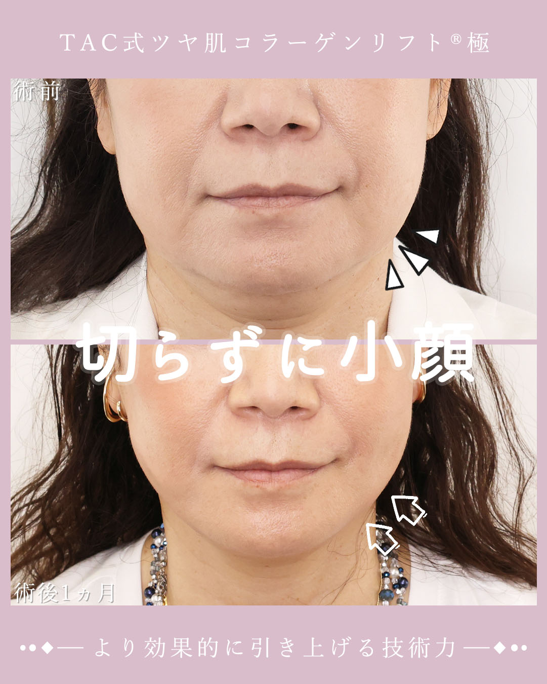 TAC式 ツヤ肌コラーゲンリフト®/ジョールファット除去/顔の脂肪吸引の症例写真 施術前後 