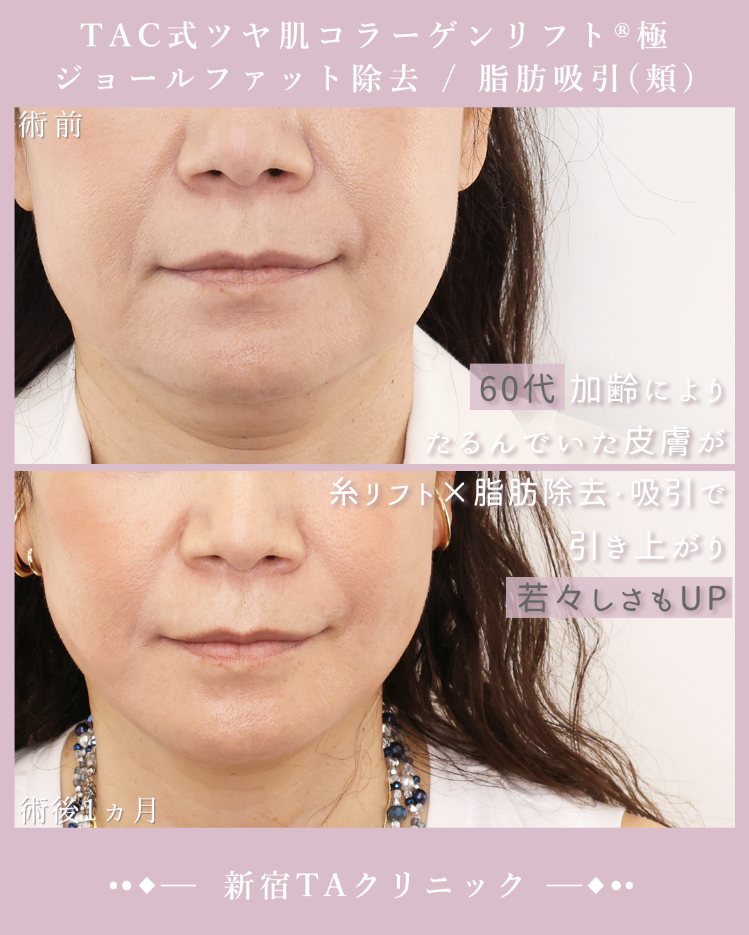 TAC式 ツヤ肌コラーゲンリフト®/ジョールファット除去/顔の脂肪吸引の症例写真 施術前後 