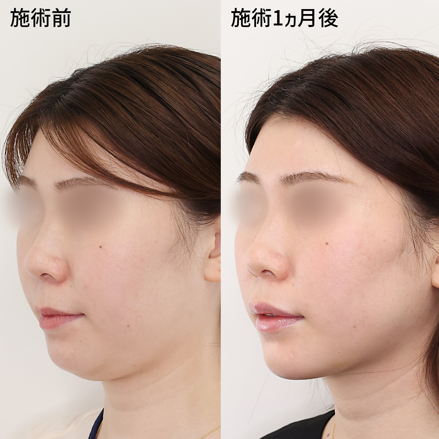 小顔複合施術【パーフェクトフェイスライン】ですっきり小顔に！