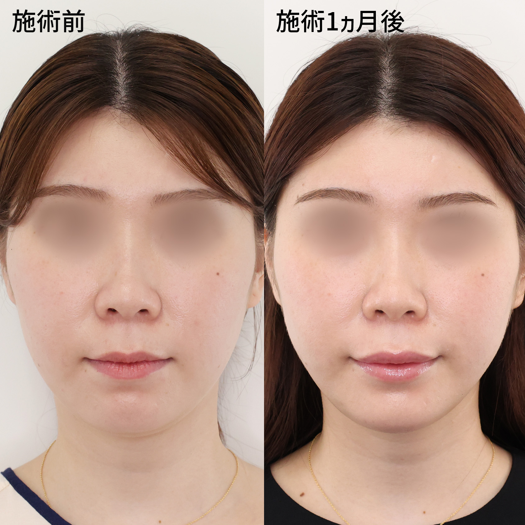 小顔整形｜パーフェクトフェイスライン/TAC式 ツヤ肌コラーゲンリフト®/顎下の脂肪吸引・顔の脂肪吸引の症例写真 施術前後 