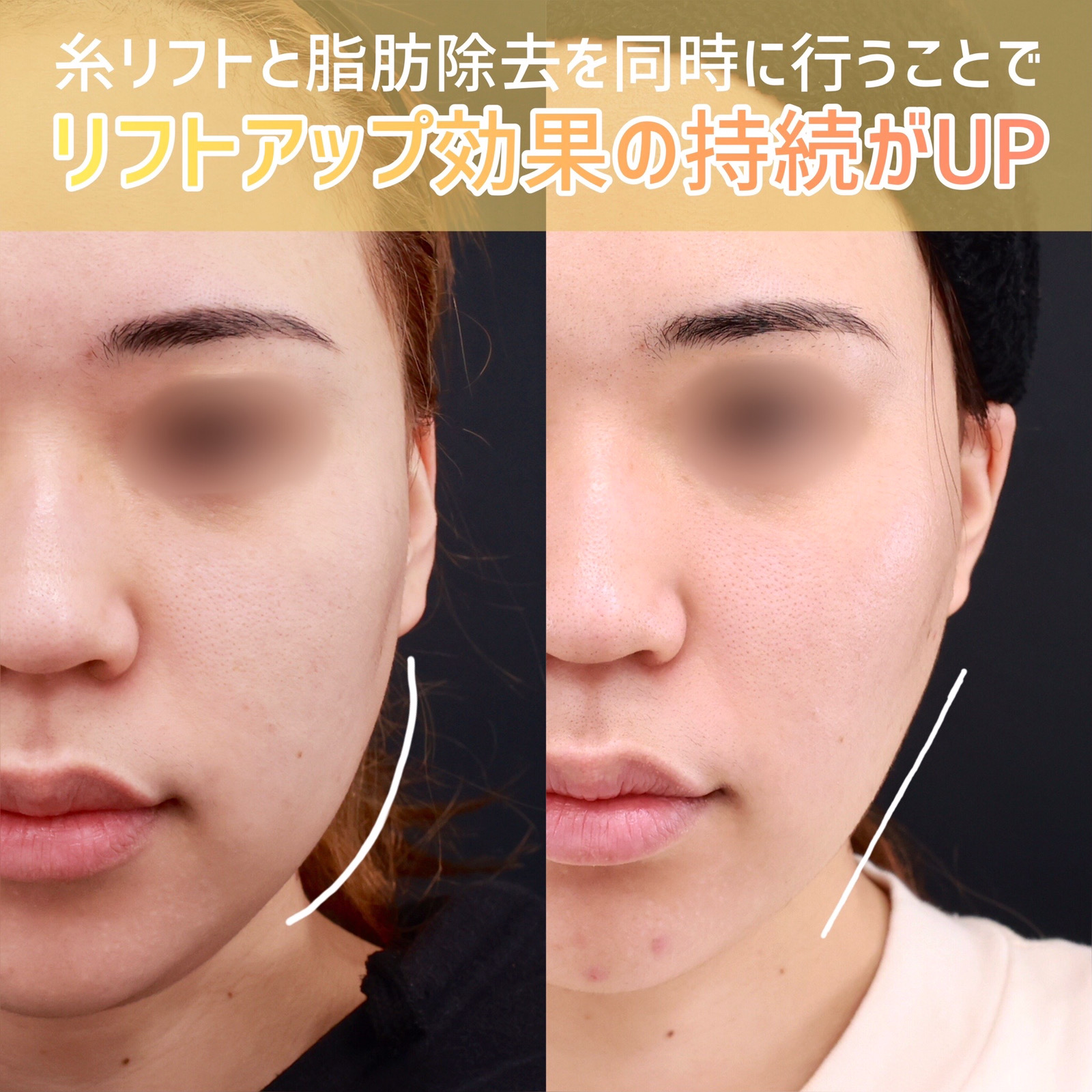 TAC式 ツヤ肌コラーゲンリフト®/バッカルファット除去/ジョールファット除去の症例写真 施術前後 術後3ヵ月経過