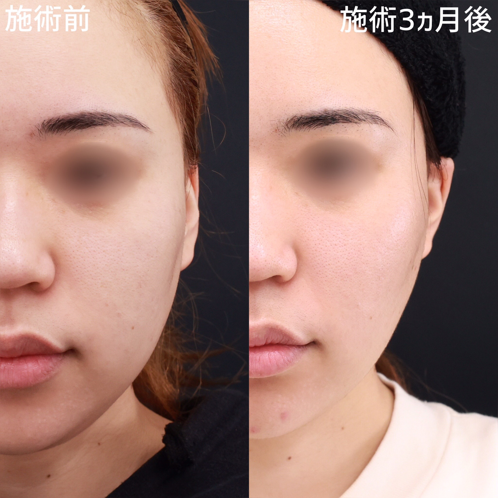 TAC式 ツヤ肌コラーゲンリフト®/バッカルファット除去/ジョールファット除去の症例写真 施術前後 