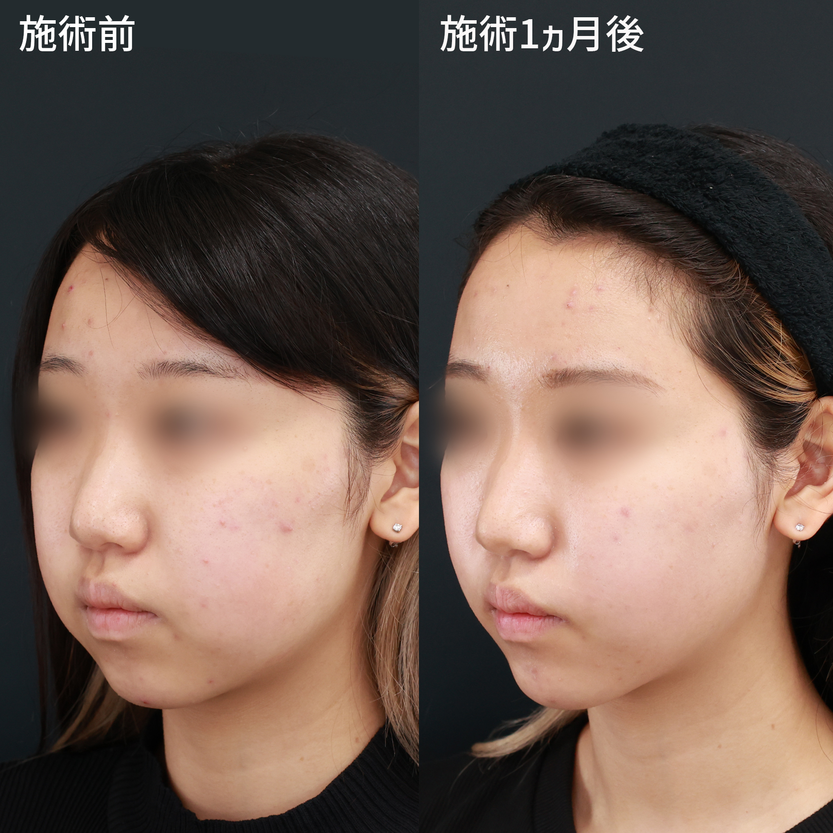 バッカルファット除去/TAC式 ツヤ肌コラーゲンリフト®/ジョールファット除去の症例写真 施術前後