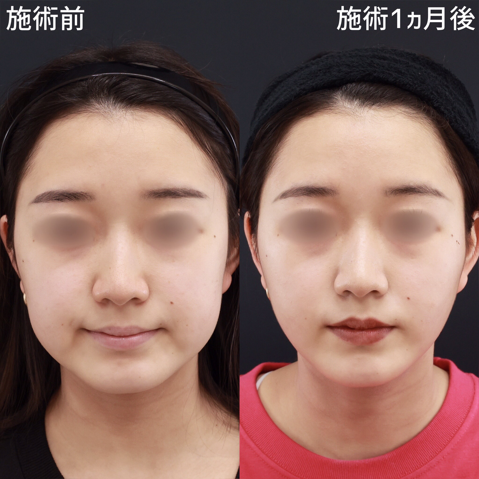 口角リフト 痛み 大阪の症例写真・画像・ビフォーアフター｜美容