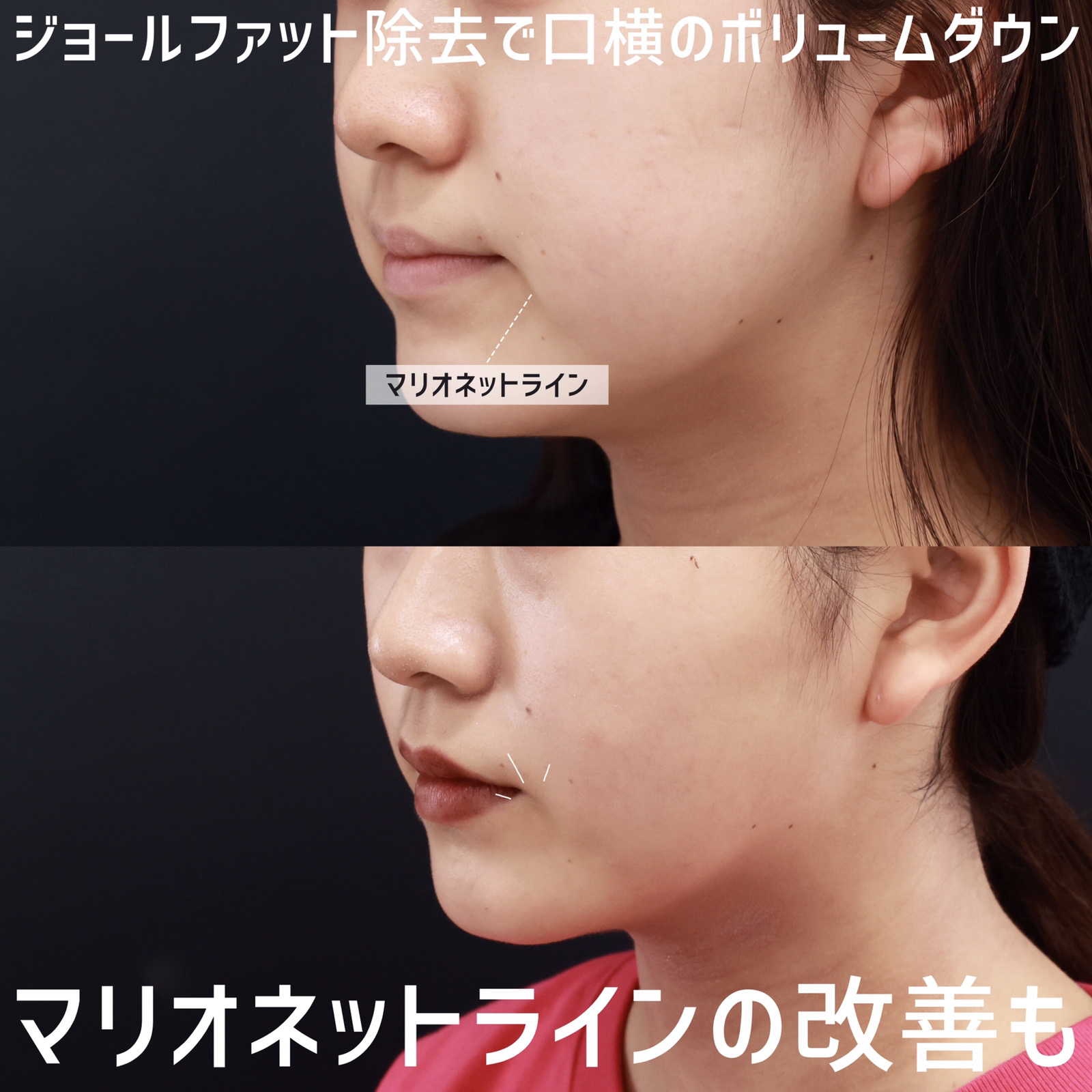 TAC式 ツヤ肌コラーゲンリフト®/ジョールファット除去の症例写真 施術前後 術後1ヵ月経過