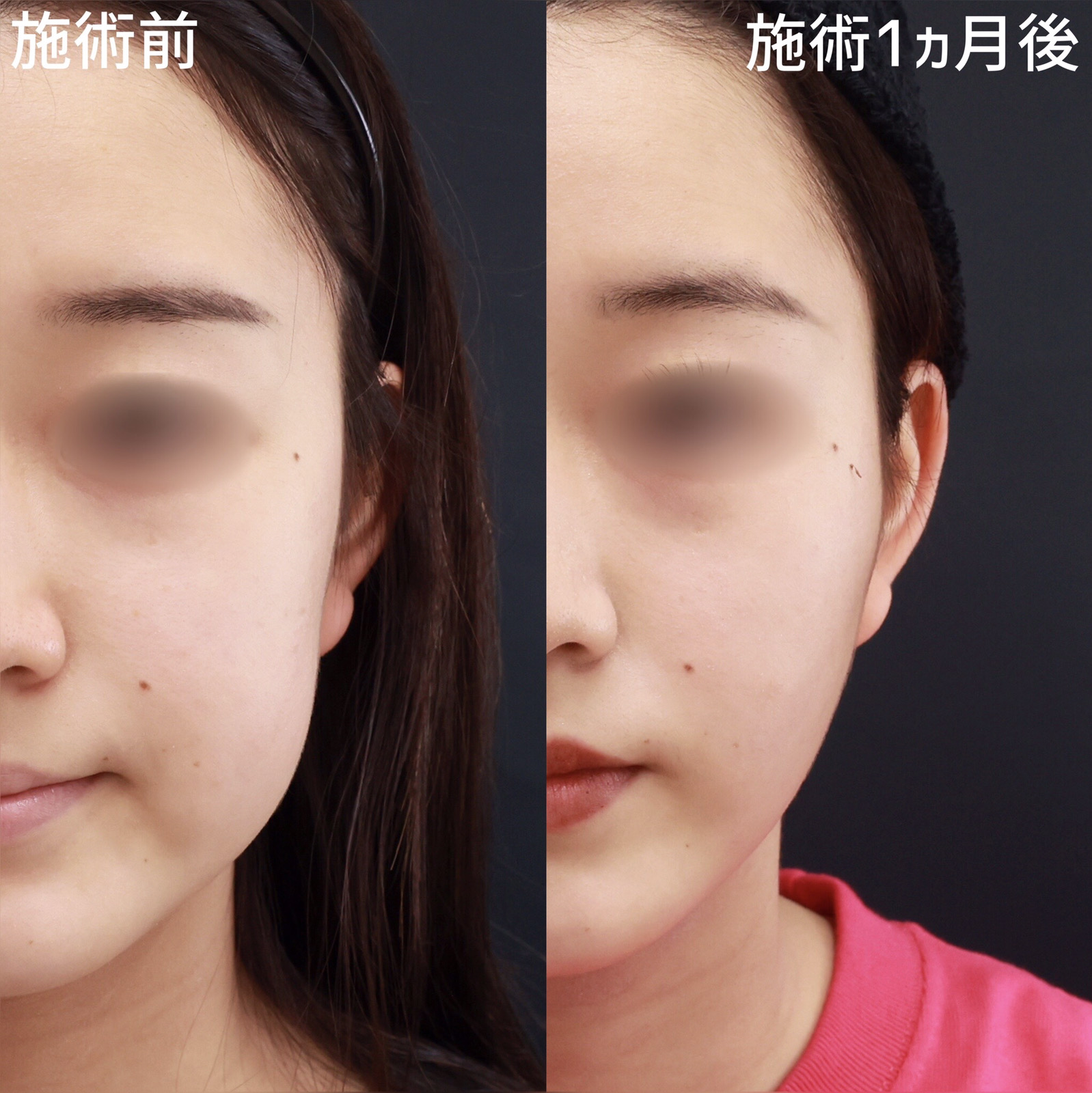 TAC式 ツヤ肌コラーゲンリフト®/ジョールファット除去の症例写真 施術前後 