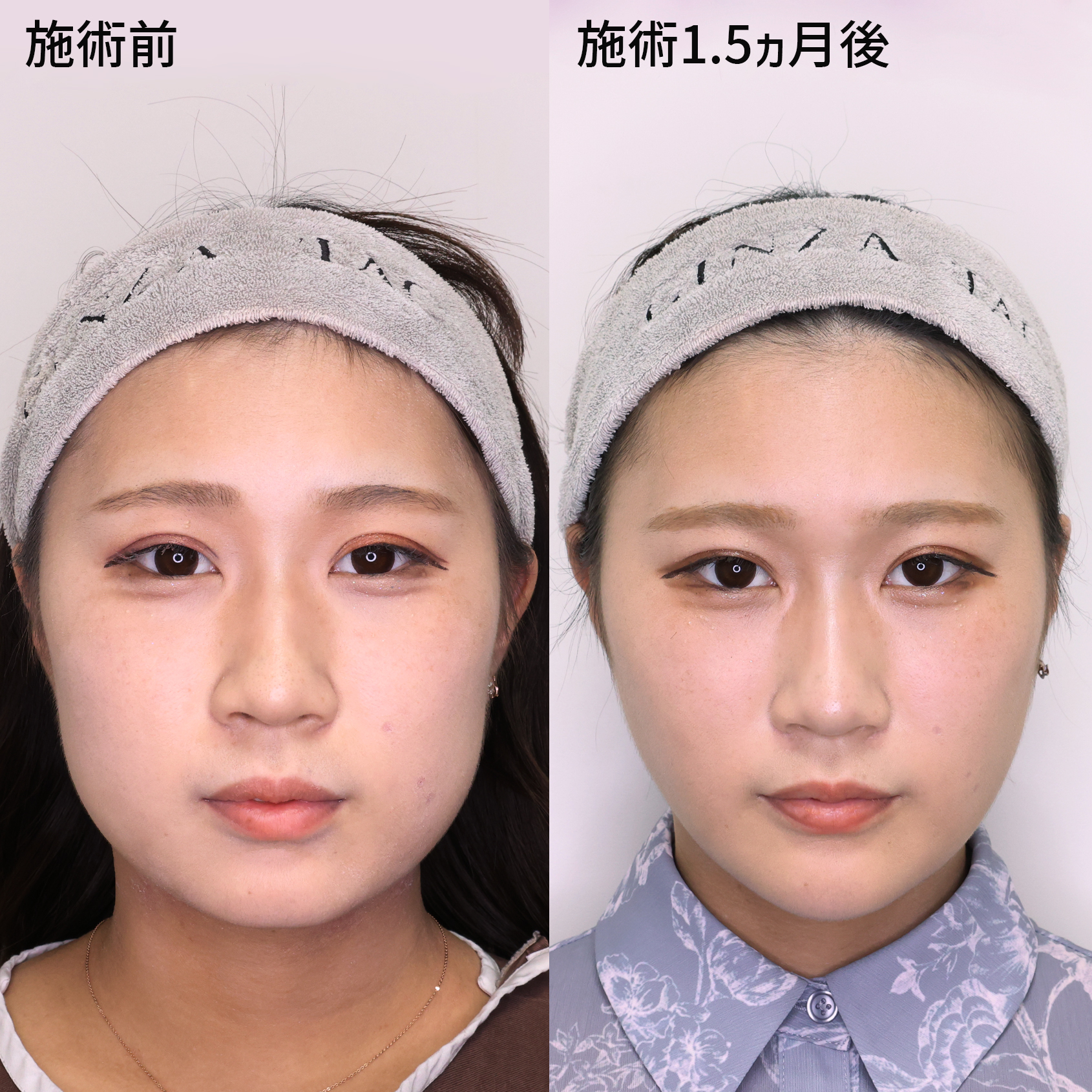 TAC式 ツヤ肌コラーゲンリフト®/バッカルファット除去/ジョールファット除去の症例写真 施術前後 