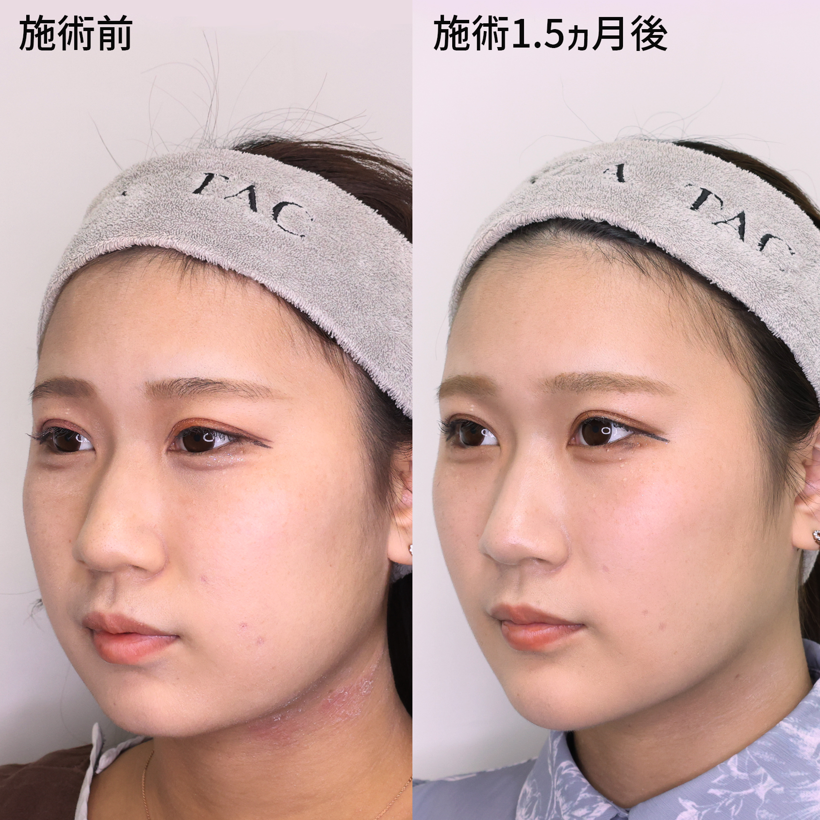 TAC式 ツヤ肌コラーゲンリフト®/バッカルファット除去/ジョールファット除去の症例写真 施術前後 