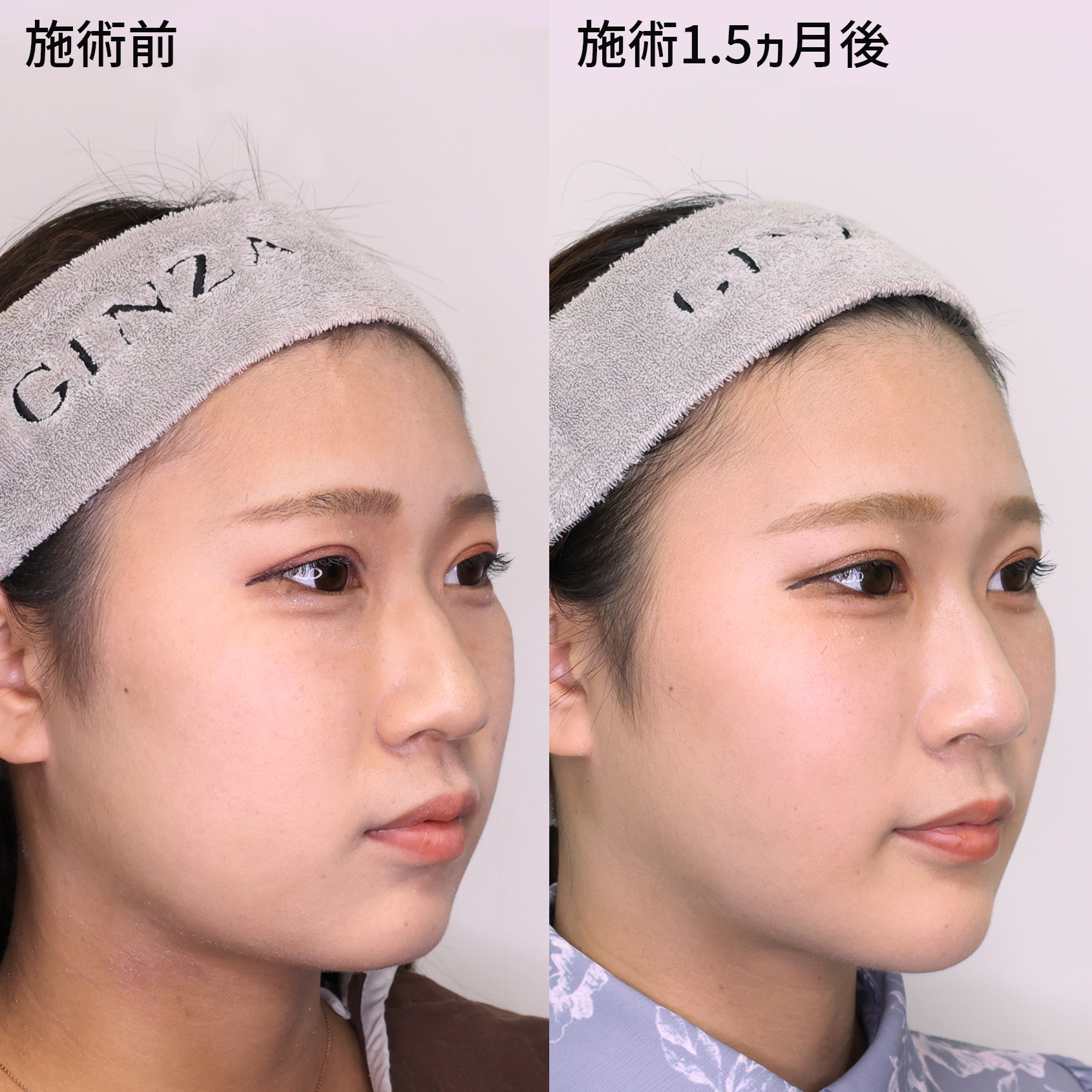 TAC式 ツヤ肌コラーゲンリフト®/バッカルファット除去/ジョールファット除去の症例写真 施術前後 