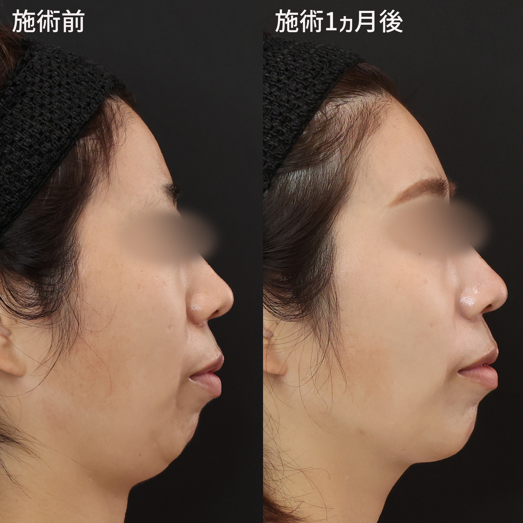 顎のヒアルロン酸注射/Lラインファット除去（エラ下脂肪除去）/TAC式 ツヤ肌コラーゲンリフト®の症例写真 施術前後 