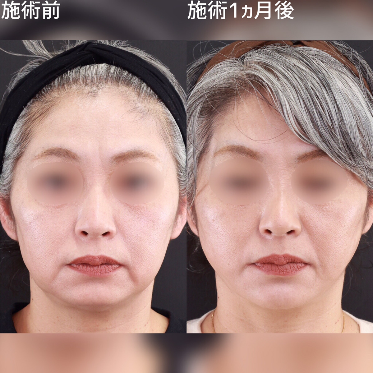 小顔施術で口周りとフェイスラインをスッキリ！