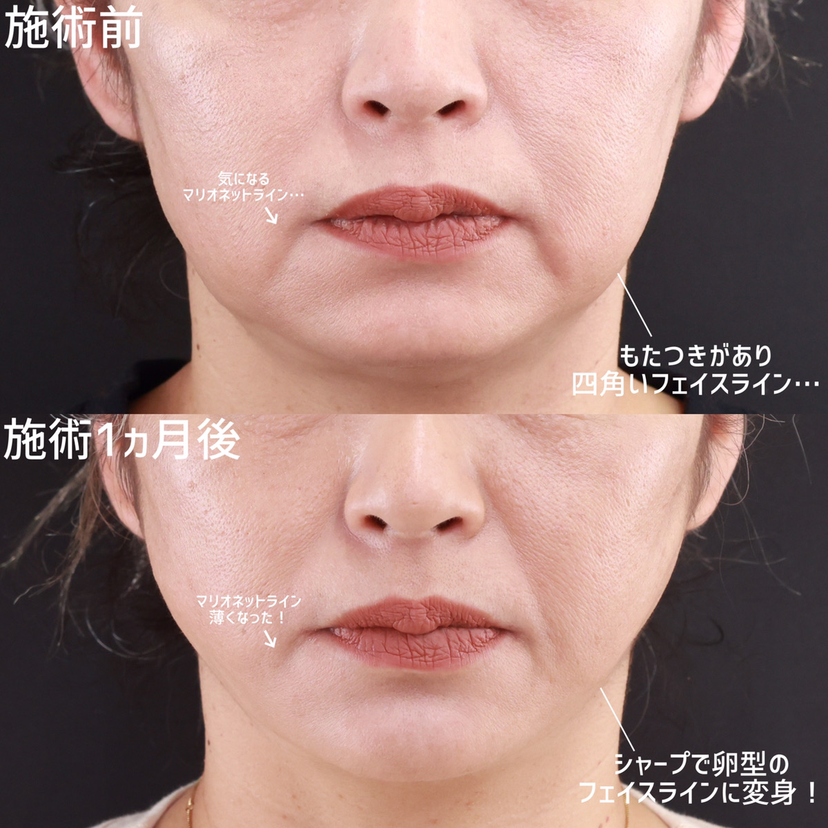 TAC式 ツヤ肌コラーゲンリフト®/ジョールファット除去/顎のヒアルロン酸注射の症例写真 施術前後 