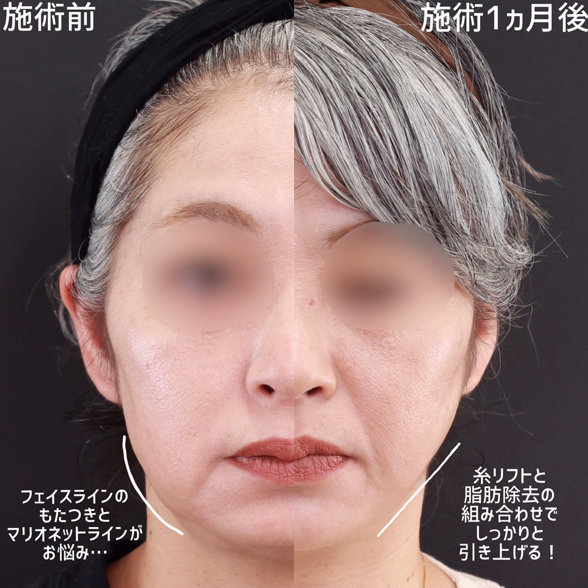 TAC式 ツヤ肌コラーゲンリフト®/ジョールファット除去/顎のヒアルロン酸注射の症例写真 施術前後 