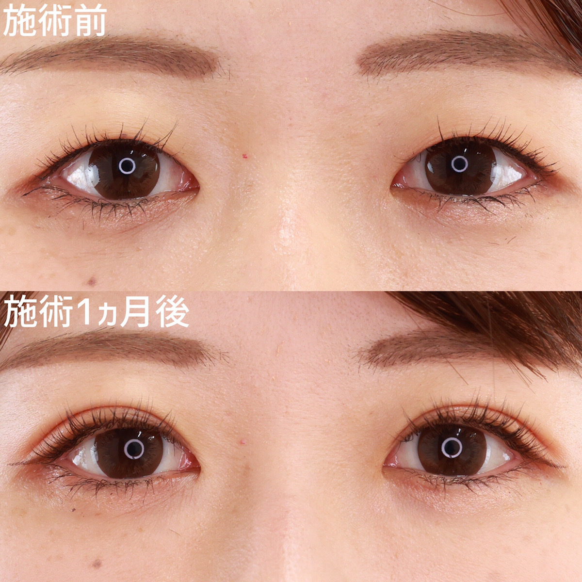 二重埋没法/目元:その他の症例写真 施術前後 1ヵ月