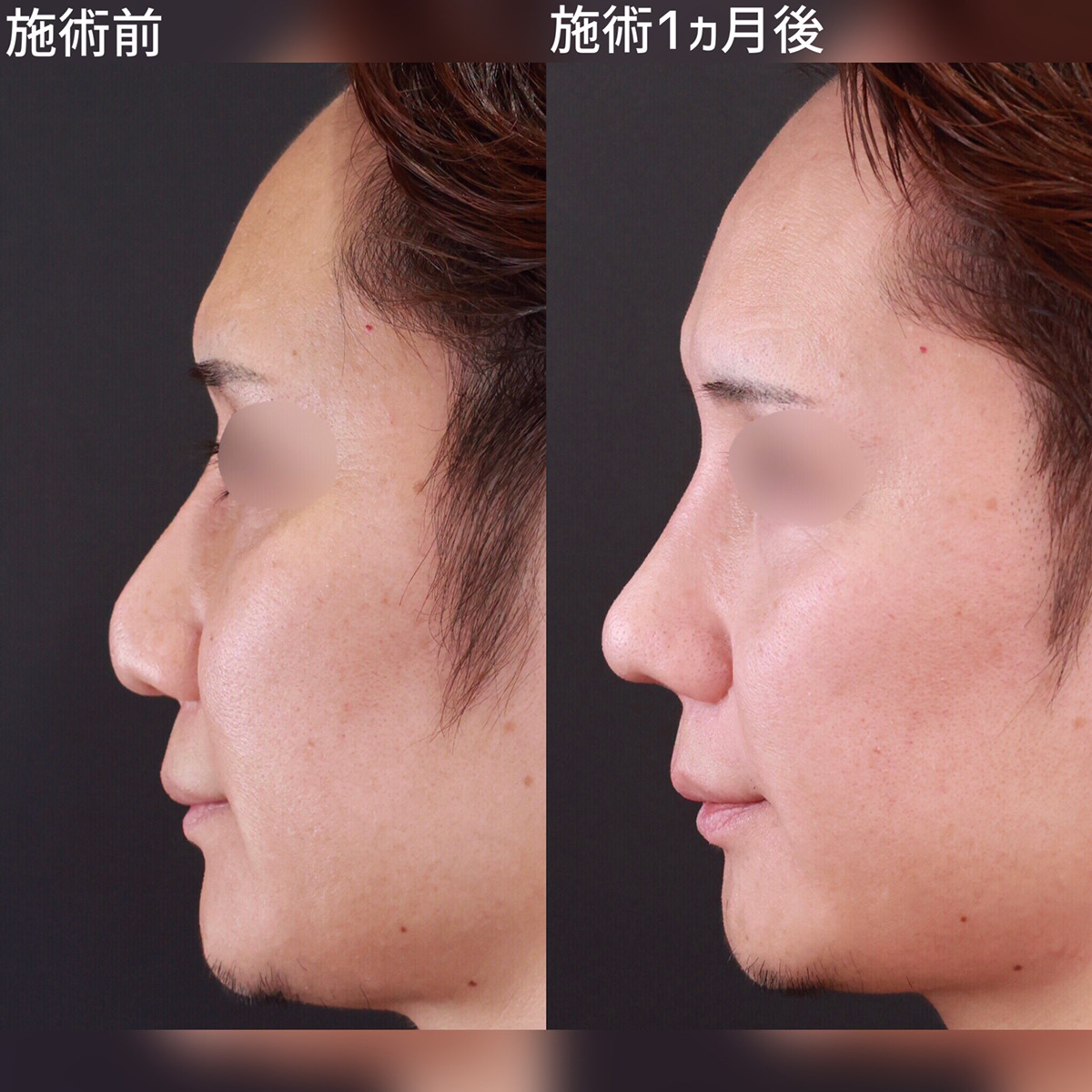 韩国赫拉做隆鼻怎么样?李丙玟的3D鼻综合技术优势是鼻形自然损伤小_最热整形行业新闻话题 - 美佳网