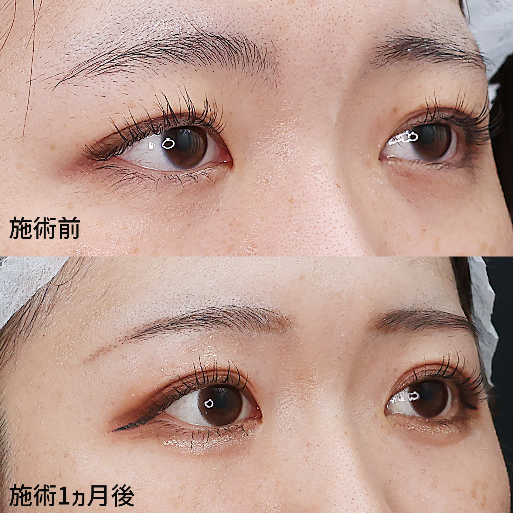 二重埋没法の症例写真 施術前後 