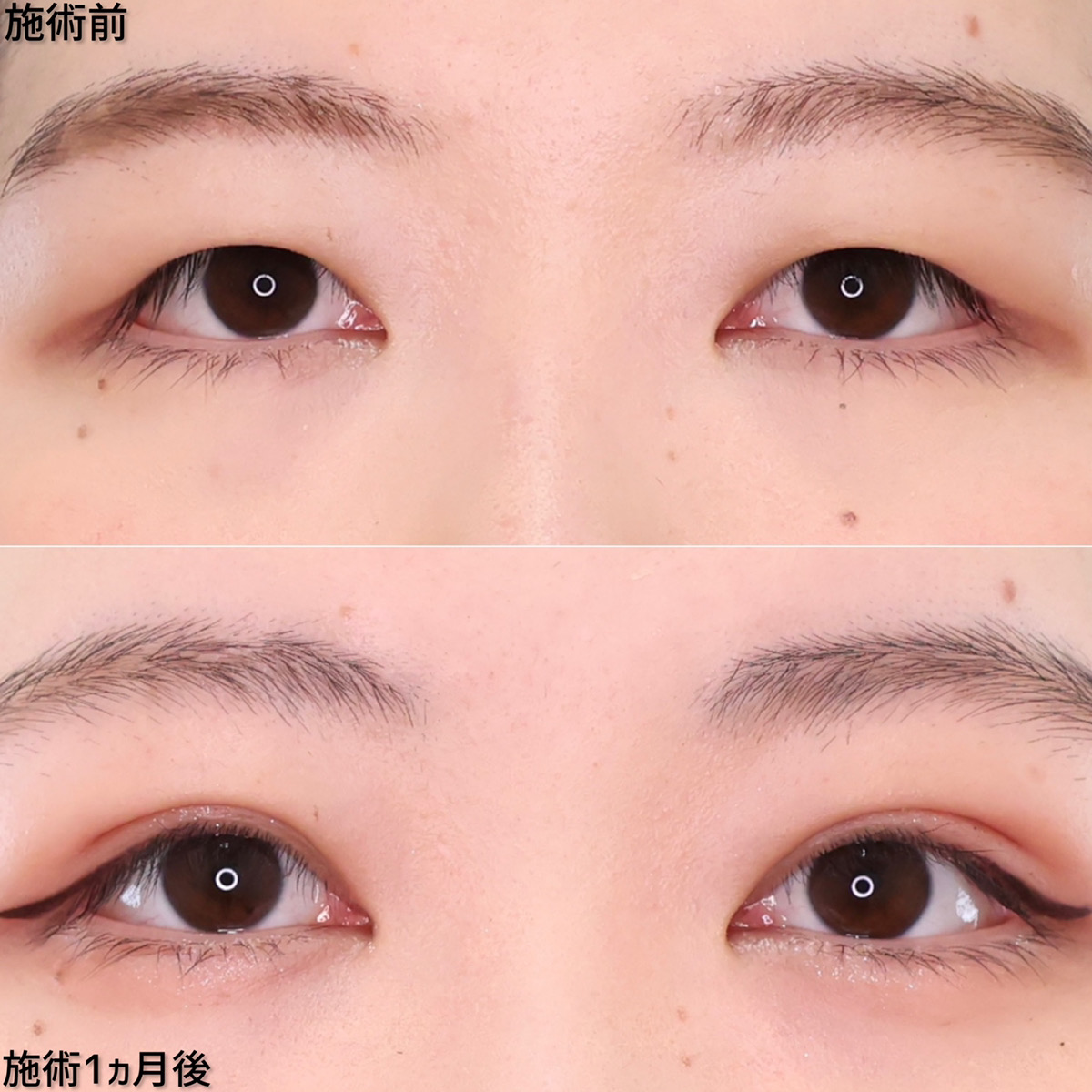 自然でバレにくい、ナチュラルMix型二重