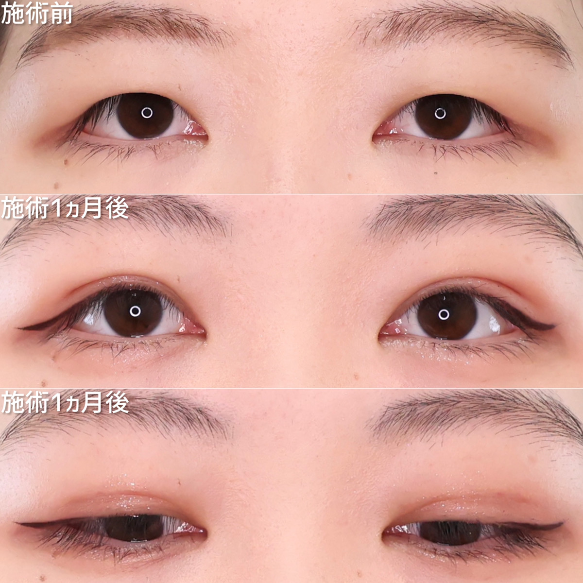 二重埋没法の症例写真 施術前後 1ヵ月