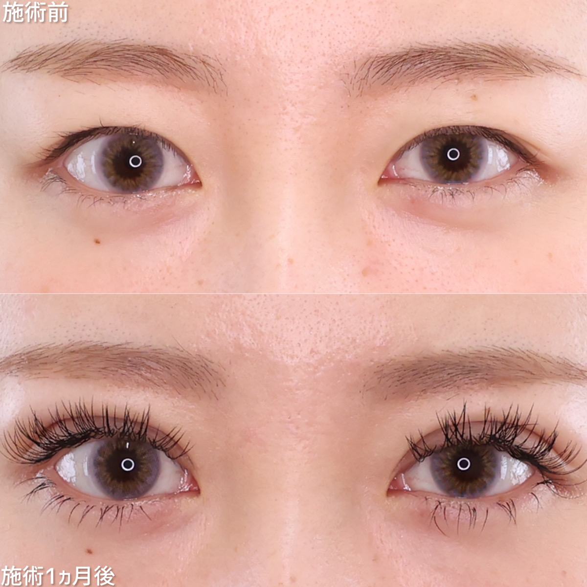 幅広平行二重でハーフのようなお目元に