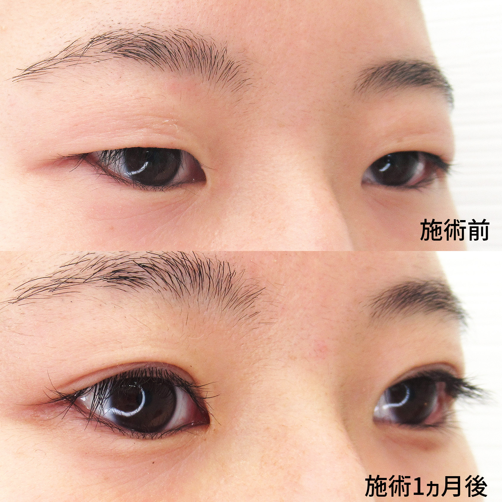 二重埋没法の症例写真 施術前後 