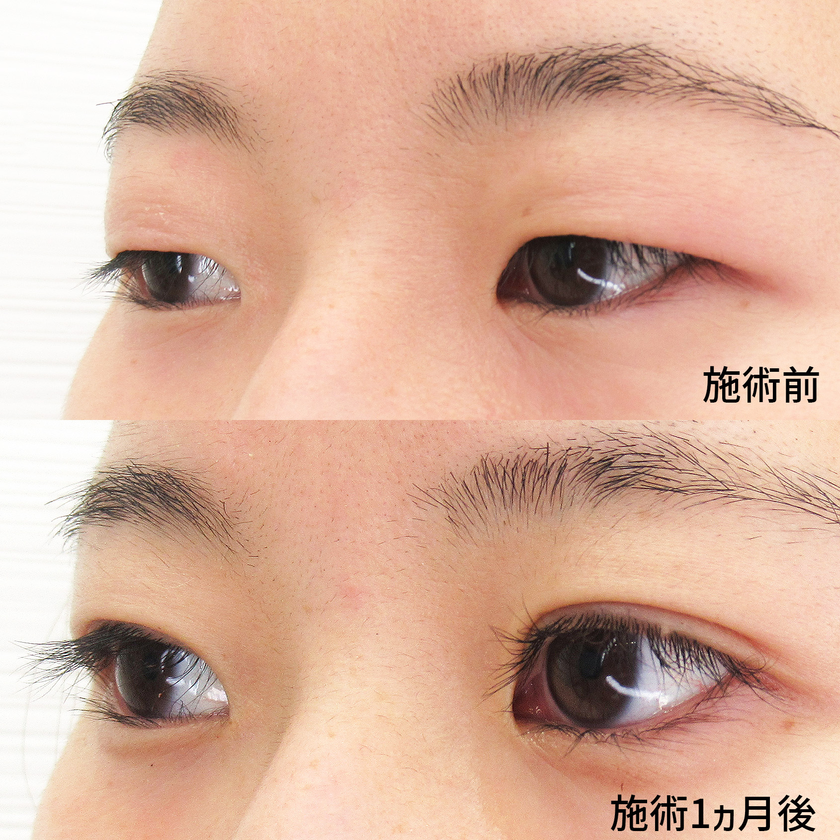 二重埋没法の症例写真 施術前後 