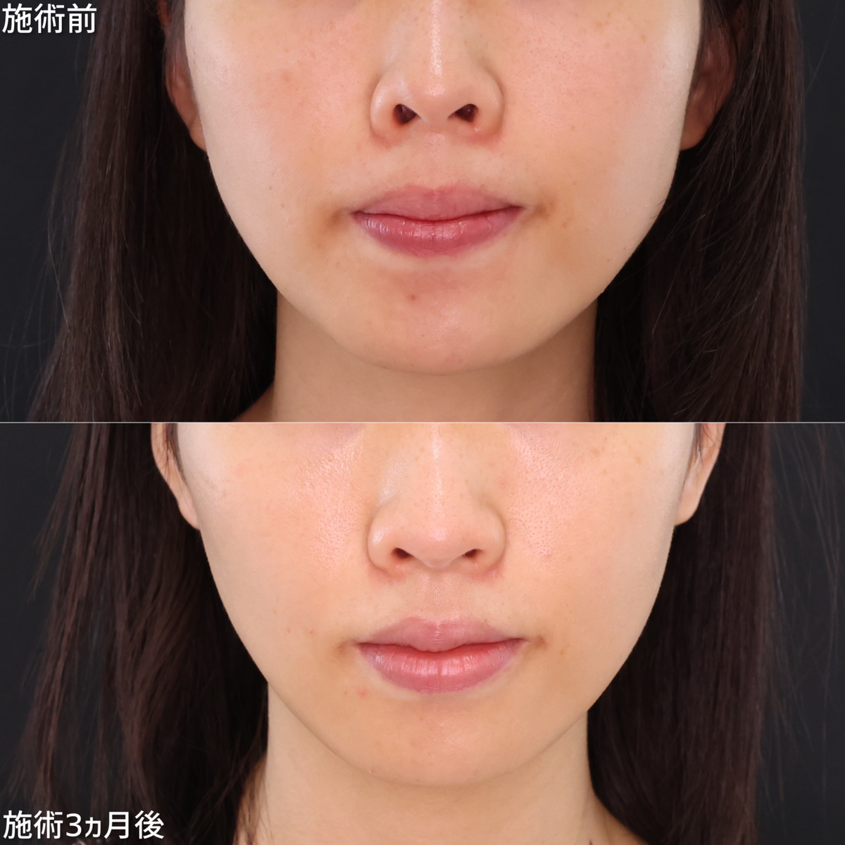 鼻孔縁下降術/鼻尖形成・鼻尖縮小/TAC式 鼻翼縮小術(小鼻縮小)の症例写真 施術前後 3ヵ月