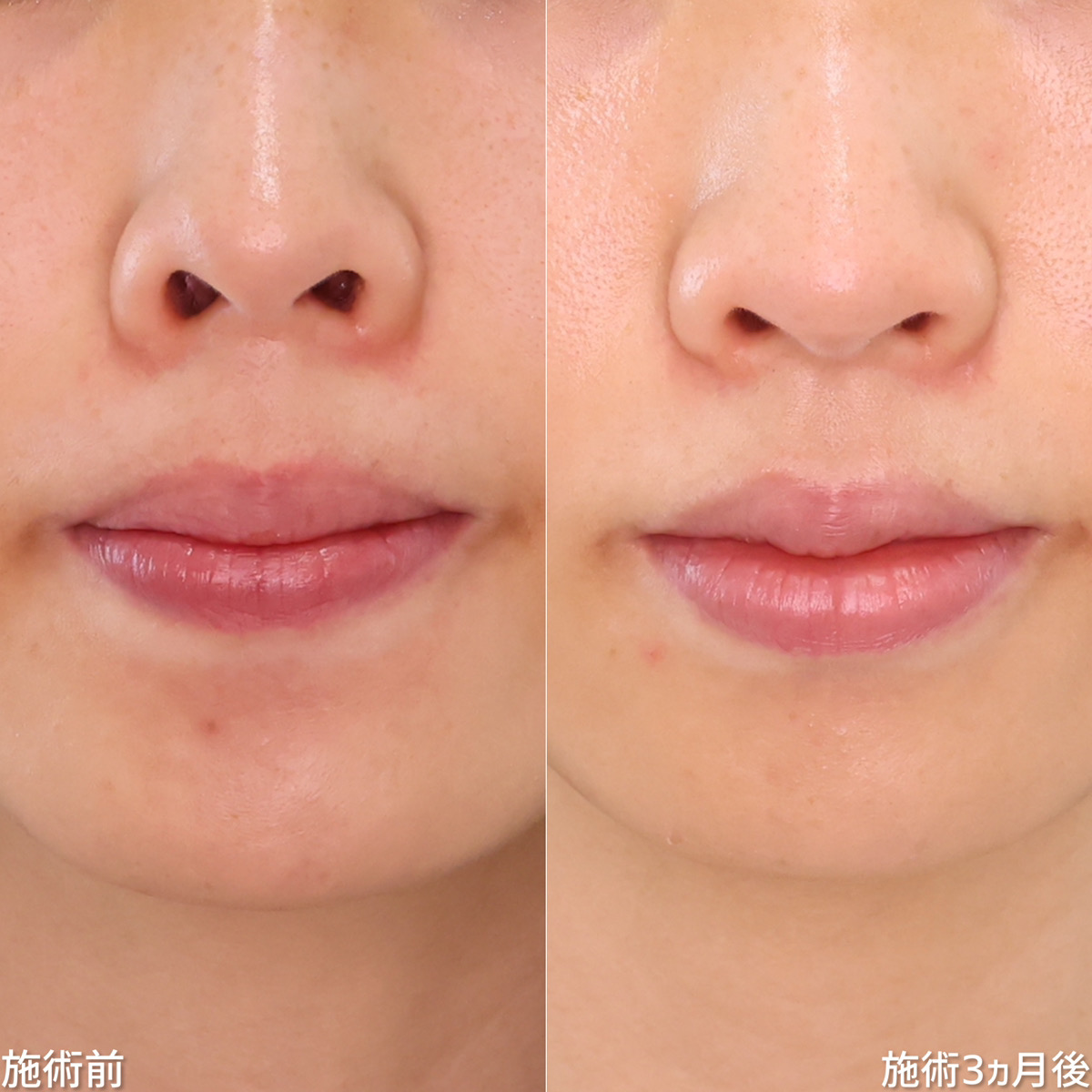 鼻孔縁下降術/鼻尖形成・鼻尖縮小/TAC式 鼻翼縮小術(小鼻縮小)の症例写真 施術前後 3ヵ月