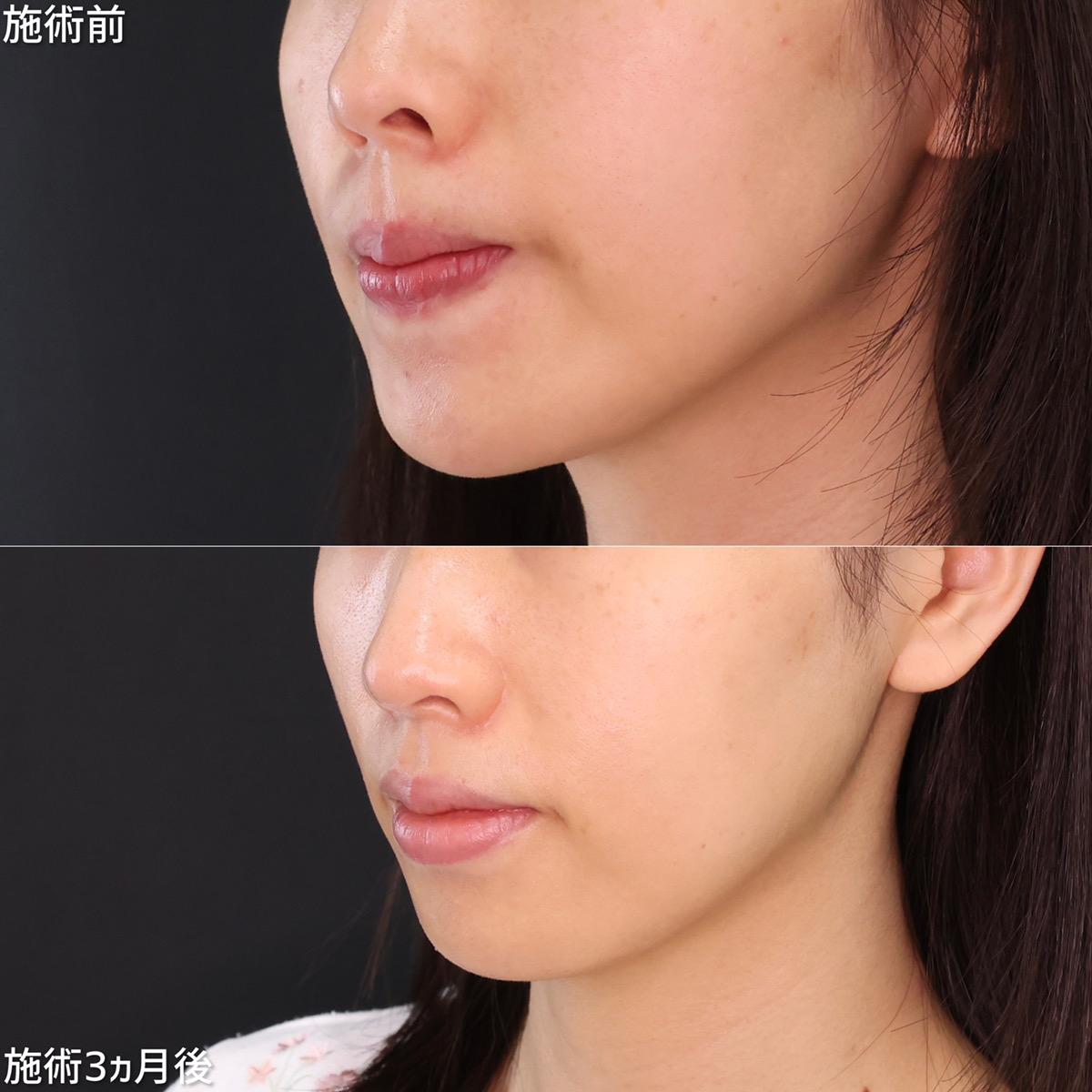 鼻孔縁下降術/鼻尖形成・鼻尖縮小/TAC式 鼻翼縮小術(小鼻縮小)の症例写真 施術前後 3ヵ月