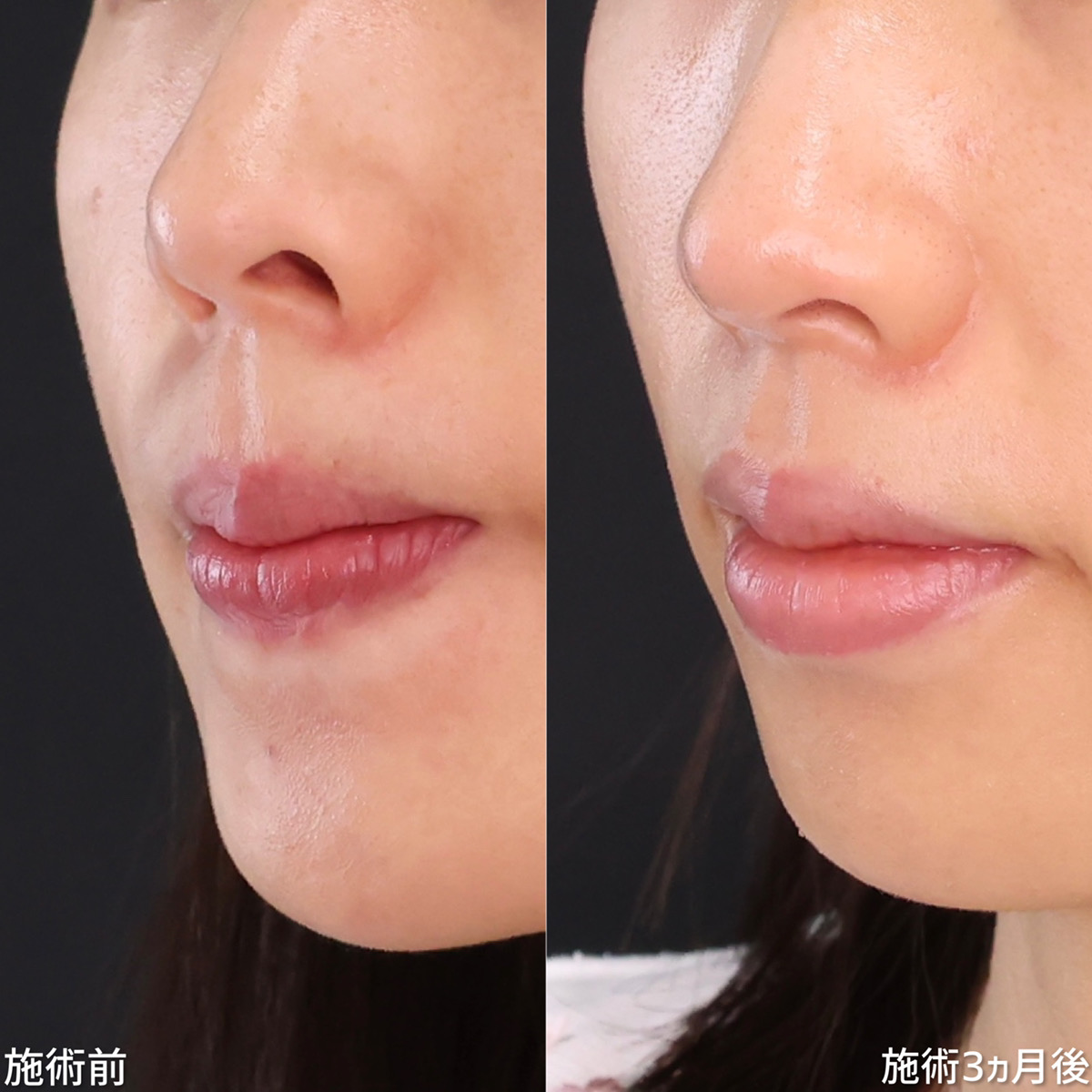 鼻孔縁下降術/鼻尖形成・鼻尖縮小/TAC式 鼻翼縮小術(小鼻縮小)の症例写真 施術前後 3ヵ月