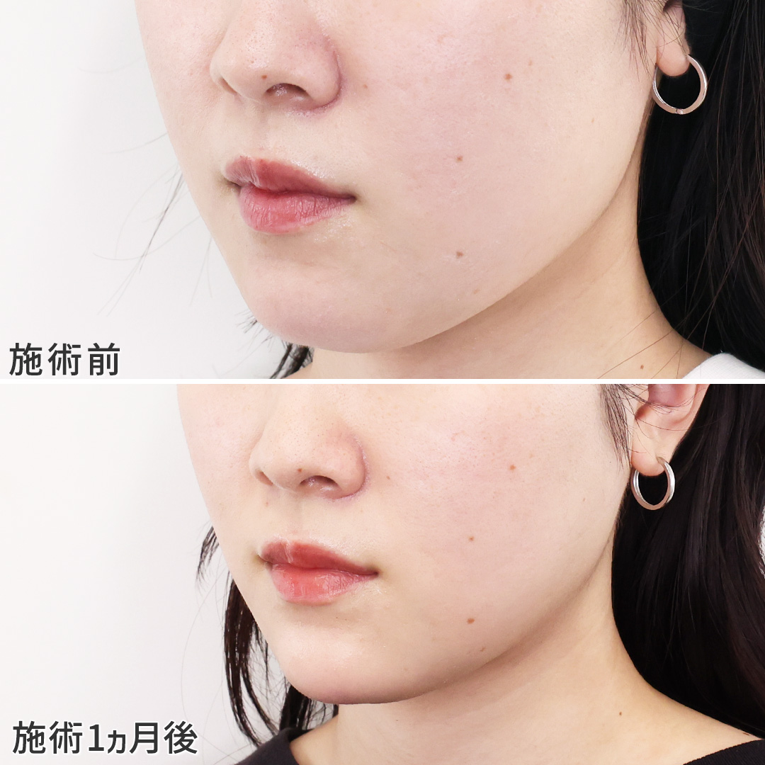 【糸リフトで】自信が持てる小顔に♡