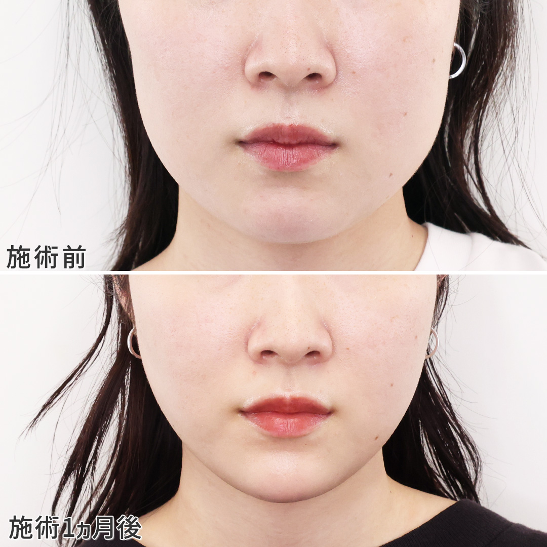 TAC式 ツヤ肌コラーゲンリフト®/顎のヒアルロン酸注射/エラボトックス注射の症例写真 施術前後 