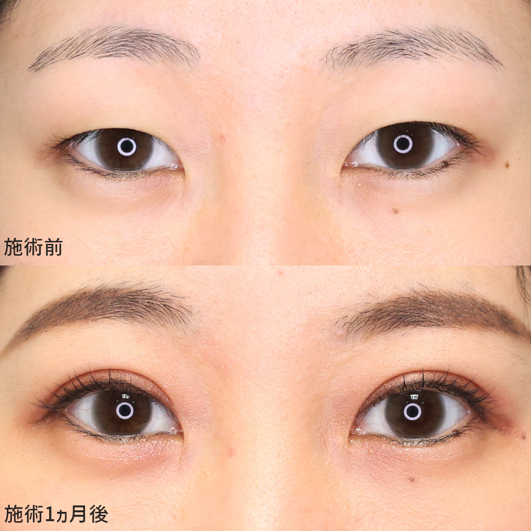 【埋没法】で叶えるぱっちり可愛らしい二重まぶたへ