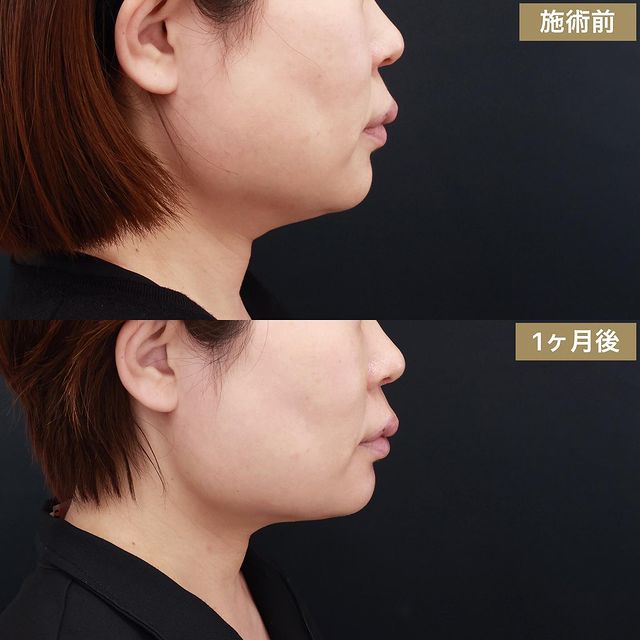 顔の脂肪吸引の症例写真 施術前後