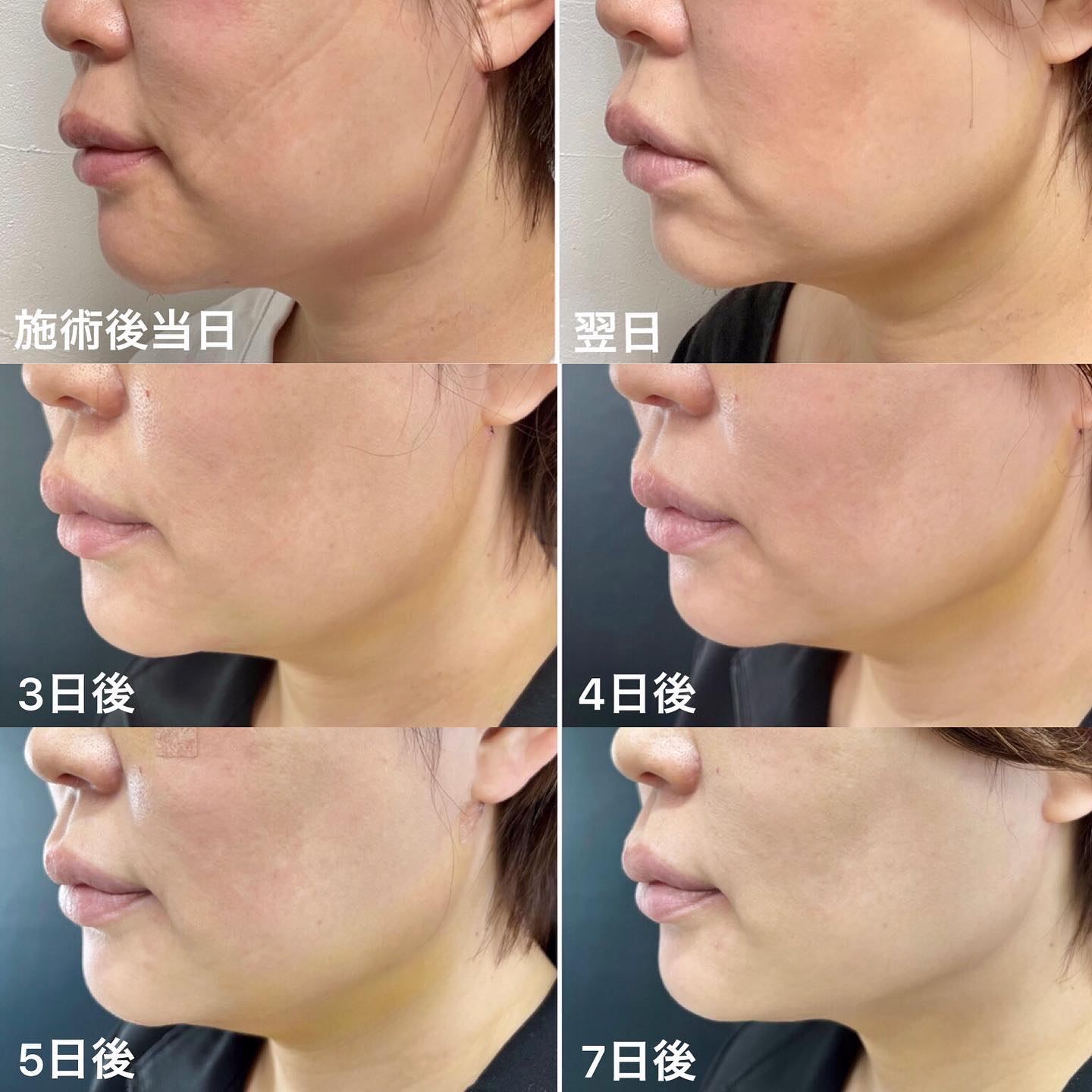 顔の脂肪吸引の症例写真 施術前後