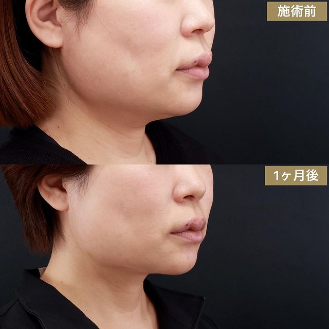 顔の脂肪吸引の症例写真 施術前後
