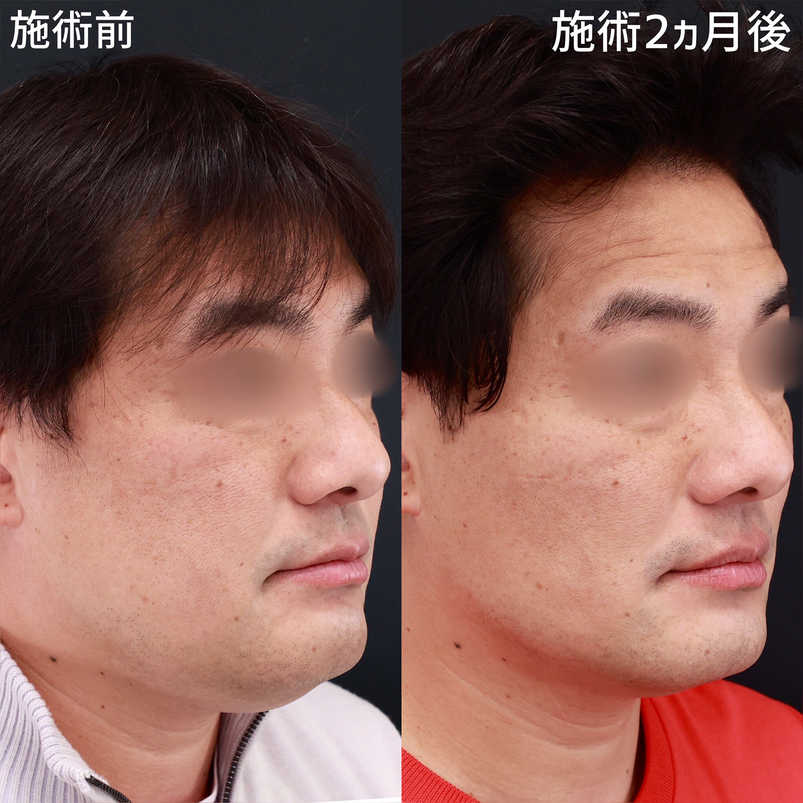 【小顔複合施術】糸リフトや脂肪吸引を組み合わせて劇的に変える