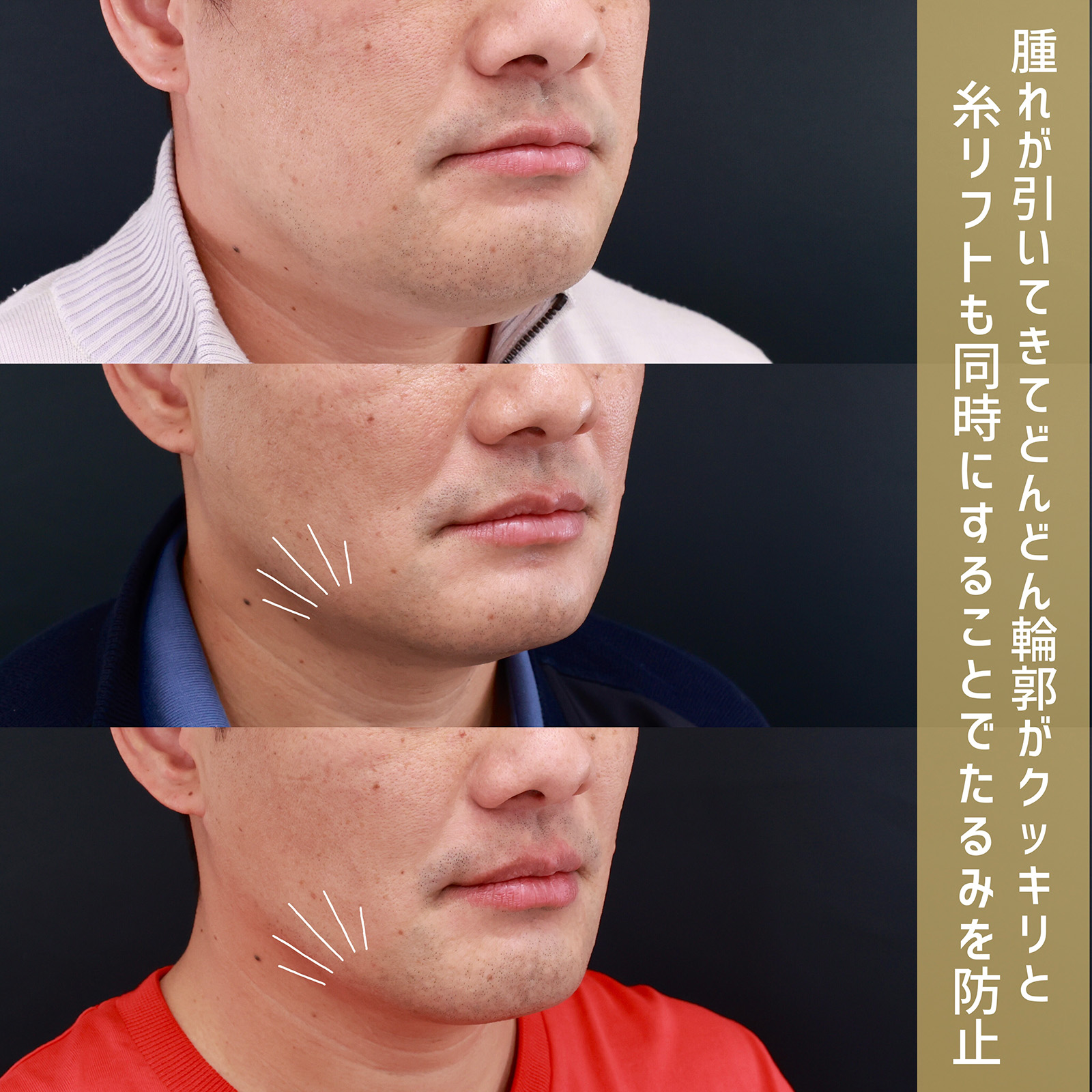 小顔整形｜パーフェクトフェイスライン/バッカルファット除去/TAC式 ツヤ肌コラーゲンリフト®の症例写真 施術前後 術前～1ヵ月～2ヵ月