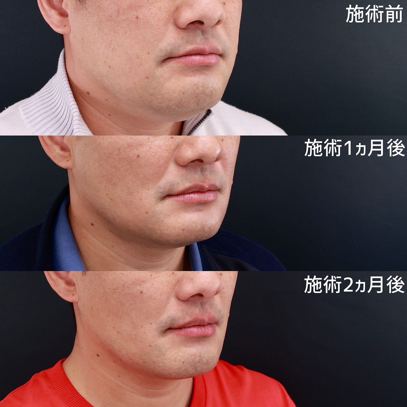 小顔整形｜パーフェクトフェイスライン/バッカルファット除去/TAC式 ツヤ肌コラーゲンリフト®の症例写真 施術前後 術前～1ヵ月～2ヵ月