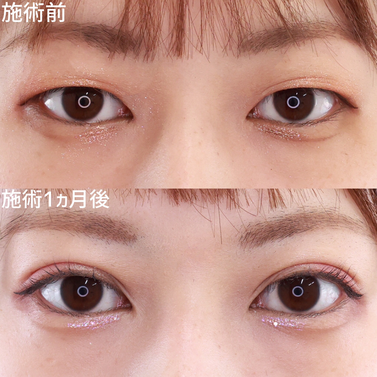 埋没法で自分に似合う二重に