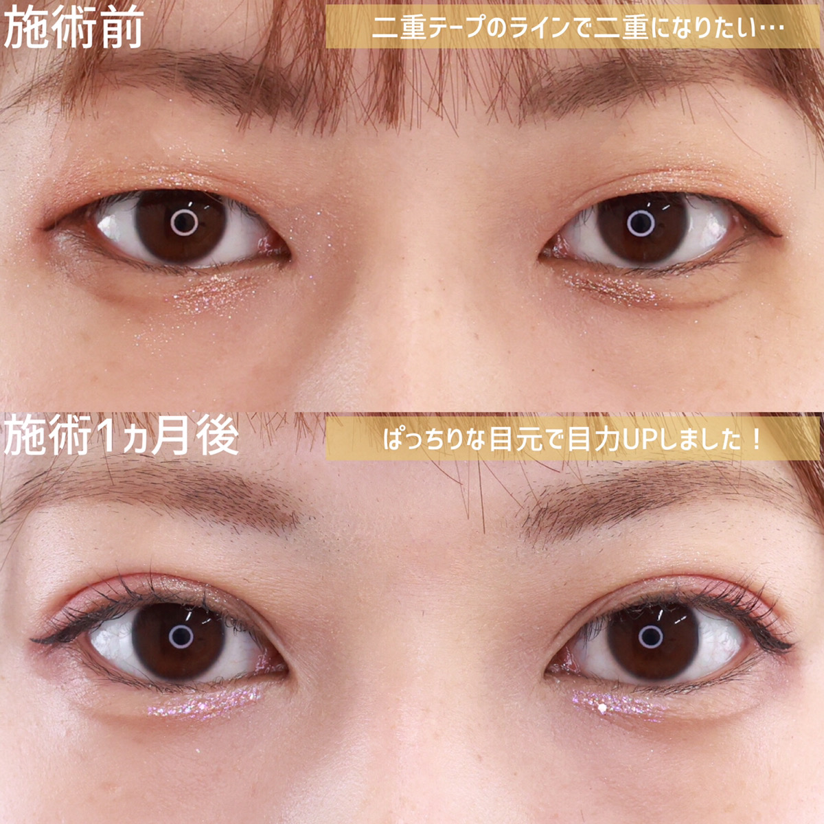 二重埋没法/目元：その他の症例写真 施術前後 